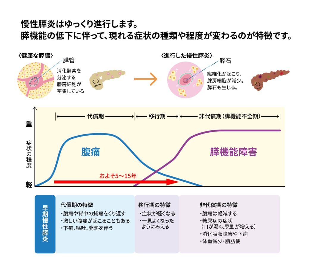 慢性膵炎の病期とすい臓の状態を説明する図